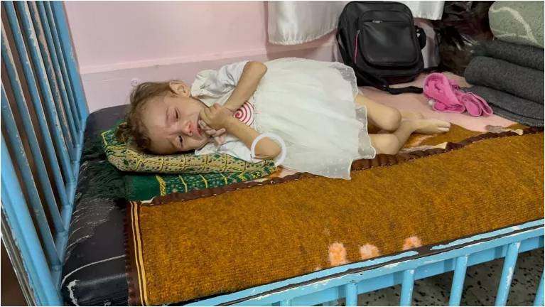 El 5 de junio de 2025, Mariam, de 2 años, yace en una cama del Hospital Nasser, en Khan Younis, Franja de Gaza. Mariam sufre desnutrición aguda. Pesa solo 5 kilos, menos de la mitad del peso promedio para su edad, que debería rondar los 11 kilos. Su madre cuenta que nació sana, pero hace unos meses comenzó a perder peso. Ahora, está tan débil que a veces no puede ni comer, y su agotamiento es evidente. Mariam necesita con urgencia tratamiento médico y apoyo nutricional adecuado para sobrevivir.
